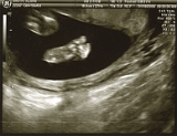 3rd Ultrasound 01
